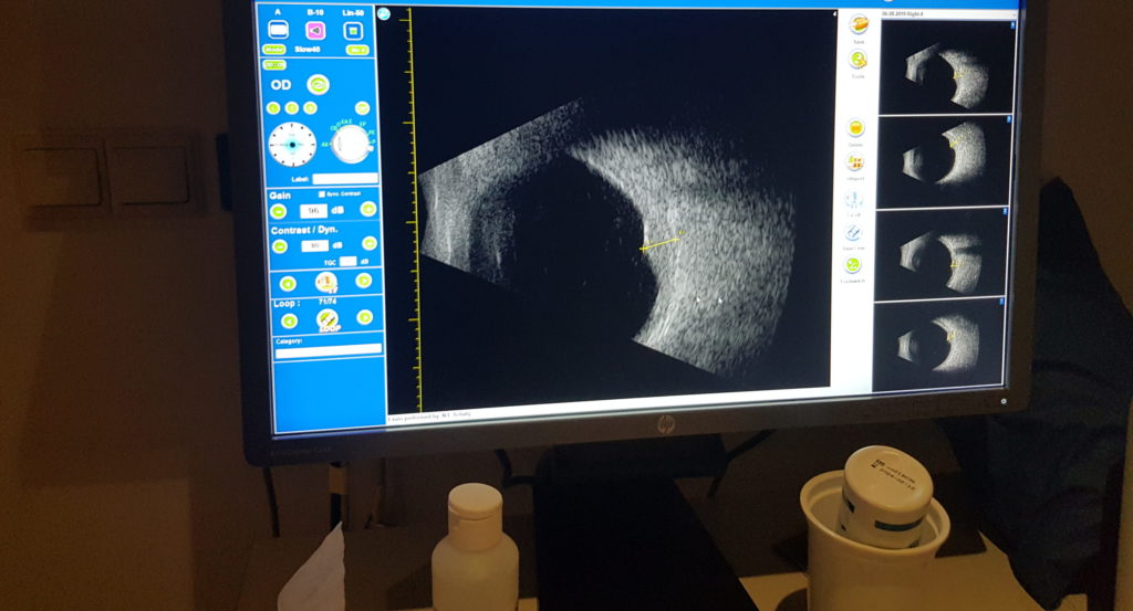 Echo scan van het oog